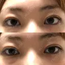 二重切開 松下皮フ形成外科 DAY 51 サムネイル用