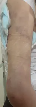 脂肪吸引（二の腕） / その他（ボディ） 銀座マイアミ美容外科 DAY 1 サムネイル用