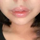 あごプロテーゼ 北尾クリニック DAY 4 サムネイル用