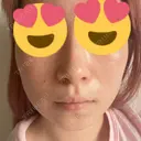 ボトックス（エラ・小顔） 湘南美容クリニック 西宮北口院 AFTER サムネイル用
