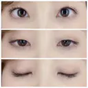 二重埋没 / 眼瞼下垂（切開） / クマ治療 / 下まぶたの脂肪取り THE MEDICAL SALON AFTER サムネイル用