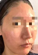 ダーマペン / 毛穴洗浄（ハイドラフェイシャルなど） AURORA CLINIC（オーロラクリニック）新宿院 DAY 2 サムネイル用