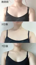 ボトックス（肩） 湘南美容クリニック 西宮北口院 DAY 7 サムネイル用