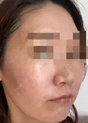 ダーマペン / 毛穴洗浄（ハイドラフェイシャルなど） AURORA CLINIC（オーロラクリニック）新宿院 DAY 2 サムネイル用