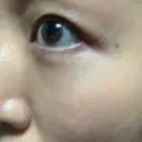 クマ治療 / 脂肪注入（肌） MIL CLINIC OSAKA DAY 32 サムネイル用