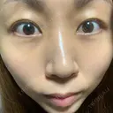 クマ治療 / 脂肪注入（肌） MIL CLINIC OSAKA AFTER サムネイル用