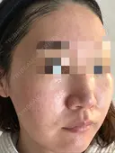 ダーマペン / 毛穴洗浄（ハイドラフェイシャルなど） AURORA CLINIC（オーロラクリニック）新宿院 DAY 3 サムネイル用