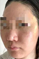 ダーマペン / 毛穴洗浄（ハイドラフェイシャルなど） AURORA CLINIC（オーロラクリニック）新宿院 DAY 3 サムネイル用