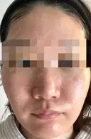 ダーマペン / 毛穴洗浄（ハイドラフェイシャルなど） AURORA CLINIC（オーロラクリニック）新宿院 DAY 3 サムネイル用