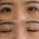 二重切開 城本クリニック 福岡院 AFTER サムネイル用
