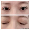 二重切開 松下皮フ形成外科 DAY 11 サムネイル用