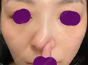 軟骨移植 フェアクリニック川口 DAY 24 サムネイル用