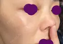軟骨移植 フェアクリニック川口 DAY 24 サムネイル用