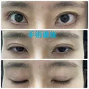 二重埋没 オジスキンクリニック DAY 0 サムネイル用