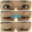 二重埋没 オジスキンクリニック DAY 0 サムネイル用