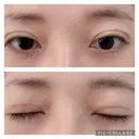 二重切開 松下皮フ形成外科 DAY 12 サムネイル用