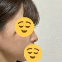 隆鼻術 / 鼻尖縮小 / ヒアルロン酸注入（鼻） 品川美容外科 福岡院 DAY 11 サムネイル用