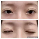 二重切開 松下皮フ形成外科 DAY 13 サムネイル用