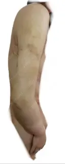 脂肪吸引（二の腕） / その他（ボディ） 銀座マイアミ美容外科 DAY 3 サムネイル用