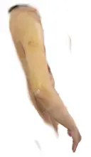 脂肪吸引（二の腕） / その他（ボディ） 銀座マイアミ美容外科 DAY 5 サムネイル用