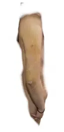 脂肪吸引（二の腕） / その他（ボディ） 銀座マイアミ美容外科 AFTER サムネイル用