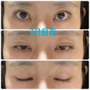 二重埋没 オジスキンクリニック DAY 2 サムネイル用