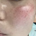 美肌レーザー / シミ取りレーザー たかはし形成外科･美容外科  DAY 44 サムネイル用