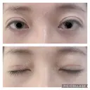 二重切開 松下皮フ形成外科 DAY 14 サムネイル用
