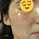 美肌レーザー / シミ取りレーザー たかはし形成外科･美容外科  DAY 44 サムネイル用