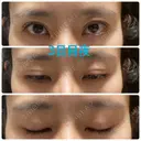 二重埋没 オジスキンクリニック AFTER サムネイル用