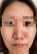 ダーマペン / 毛穴洗浄（ハイドラフェイシャルなど） AURORA CLINIC（オーロラクリニック）新宿院 DAY 8 サムネイル用