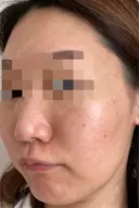 ダーマペン / 毛穴洗浄（ハイドラフェイシャルなど） AURORA CLINIC（オーロラクリニック）新宿院 DAY 8 サムネイル用