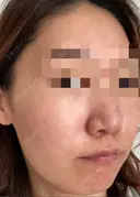 ダーマペン / 毛穴洗浄（ハイドラフェイシャルなど） AURORA CLINIC（オーロラクリニック）新宿院 AFTER サムネイル用