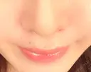 小鼻縮小（切開） / その他（鼻） みずほクリニック DAY 8 サムネイル用