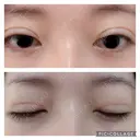 二重切開 松下皮フ形成外科 DAY 15 サムネイル用