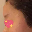 額を丸く ニューセンス皮膚科クリニック DAY 2 サムネイル用