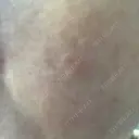 ダーマペン 湘南美容クリニック 武蔵小杉院 DAY 5 サムネイル用