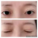 二重切開 松下皮フ形成外科 DAY 16 サムネイル用