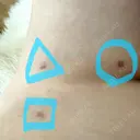 脂肪吸引（脚） / 豊胸（脂肪注入） 石倉クリニック 水戸院 DAY 22 サムネイル用