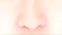 小鼻縮小（切開） / その他（鼻） みずほクリニック DAY 10 サムネイル用