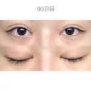 二重切開 / 目頭切開 / 上まぶたたるみ取り サラ美容外科 DAY 90 サムネイル用