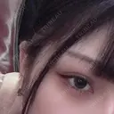 二重切開 / 目頭切開 / 上まぶたたるみ取り サラ美容外科 DAY 90 サムネイル用