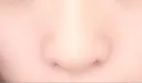 小鼻縮小（切開） / その他（鼻） みずほクリニック DAY 11 サムネイル用