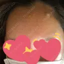 額を丸く ニューセンス皮膚科クリニック DAY 5 サムネイル用