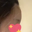 額を丸く ニューセンス皮膚科クリニック DAY 9 サムネイル用