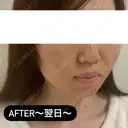 糸リフト / ヒアルロン酸注入（頬） EMMA CLINIC（エマクリニック） DAY 1 サムネイル用