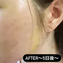 糸リフト / ヒアルロン酸注入（頬） EMMA CLINIC（エマクリニック） DAY 5 サムネイル用