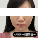 糸リフト / ヒアルロン酸注入（頬） EMMA CLINIC（エマクリニック） DAY 7 サムネイル用