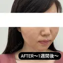 糸リフト / ヒアルロン酸注入（頬） EMMA CLINIC（エマクリニック） DAY 7 サムネイル用