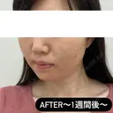 糸リフト / ヒアルロン酸注入（頬） EMMA CLINIC（エマクリニック） DAY 7 サムネイル用